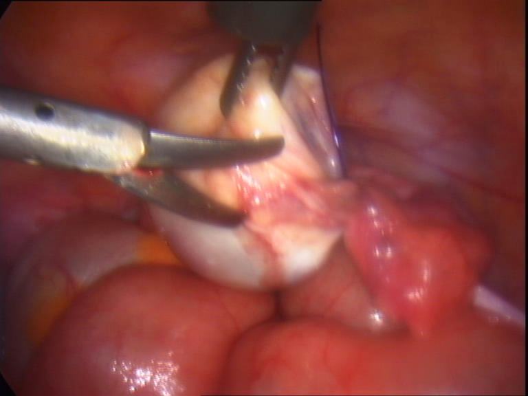 cutting the ovary off its pedicle-attachment
